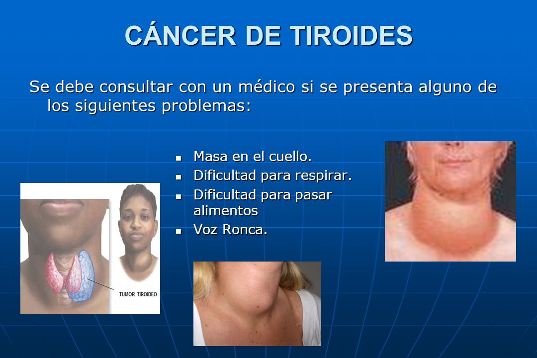 CÁNCER DE TIROIDES Se debe consultar con un médico si se presenta alguno de los siguientes problemas: