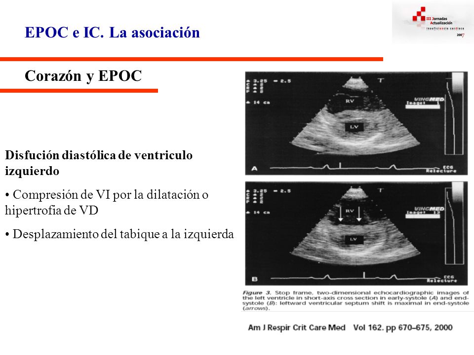 EPOC e IC. La asociación Corazón y EPOC