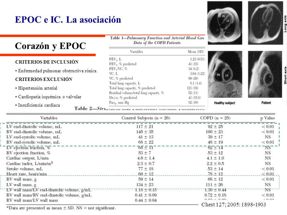 EPOC e IC. La asociación Corazón y EPOC Chest 127; 2005: