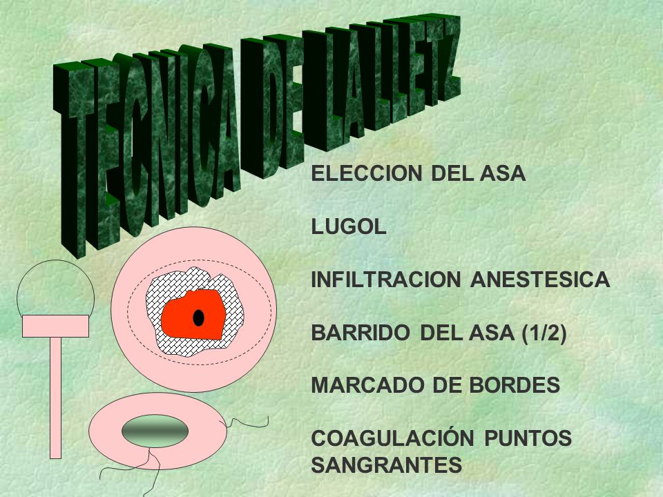 TECNICA DE LA LLETZ ELECCION DEL ASA LUGOL INFILTRACION ANESTESICA