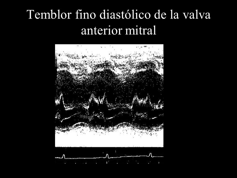 Temblor fino diastólico de la valva anterior mitral