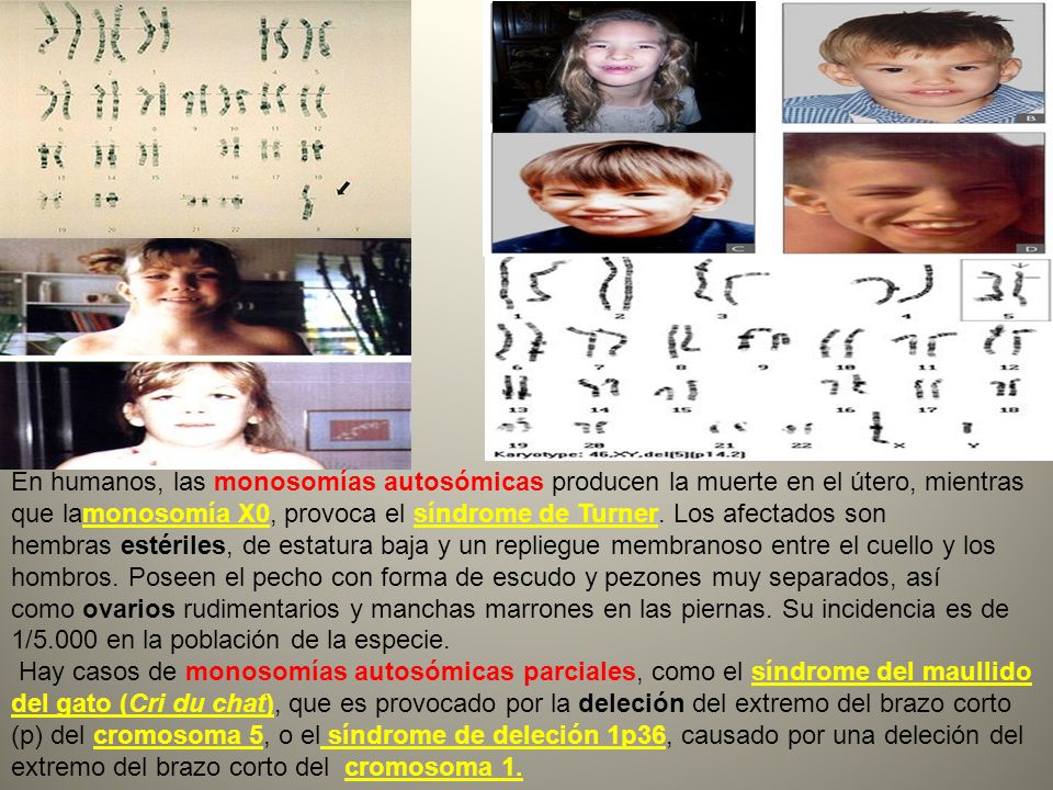 En humanos, las monosomías autosómicas producen la muerte en el útero, mientras que lamonosomía X0, provoca el síndrome de Turner. Los afectados son hembras estériles, de estatura baja y un repliegue membranoso entre el cuello y los hombros. Poseen el pecho con forma de escudo y pezones muy separados, así como ovarios rudimentarios y manchas marrones en las piernas. Su incidencia es de 1/5.000 en la población de la especie.