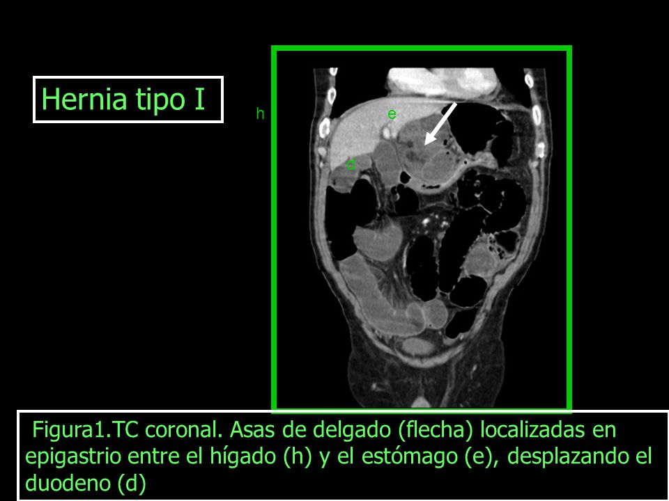Hernia tipo I h. e. d.