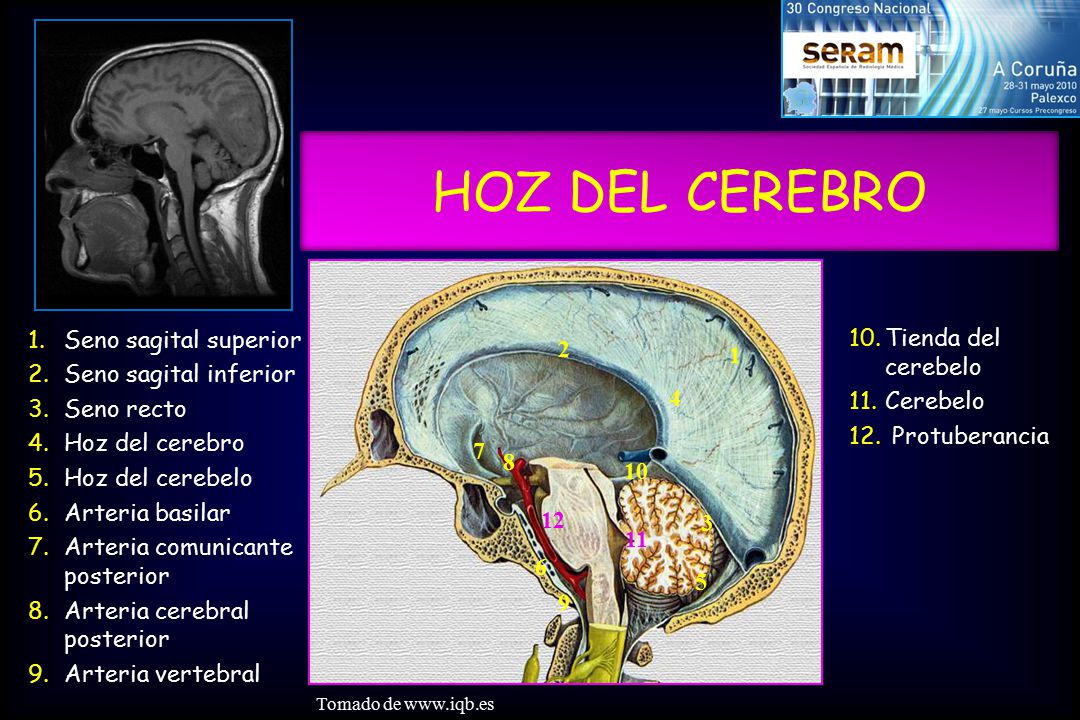 HOZ DEL CEREBRO Seno sagital superior Tienda del cerebelo 2