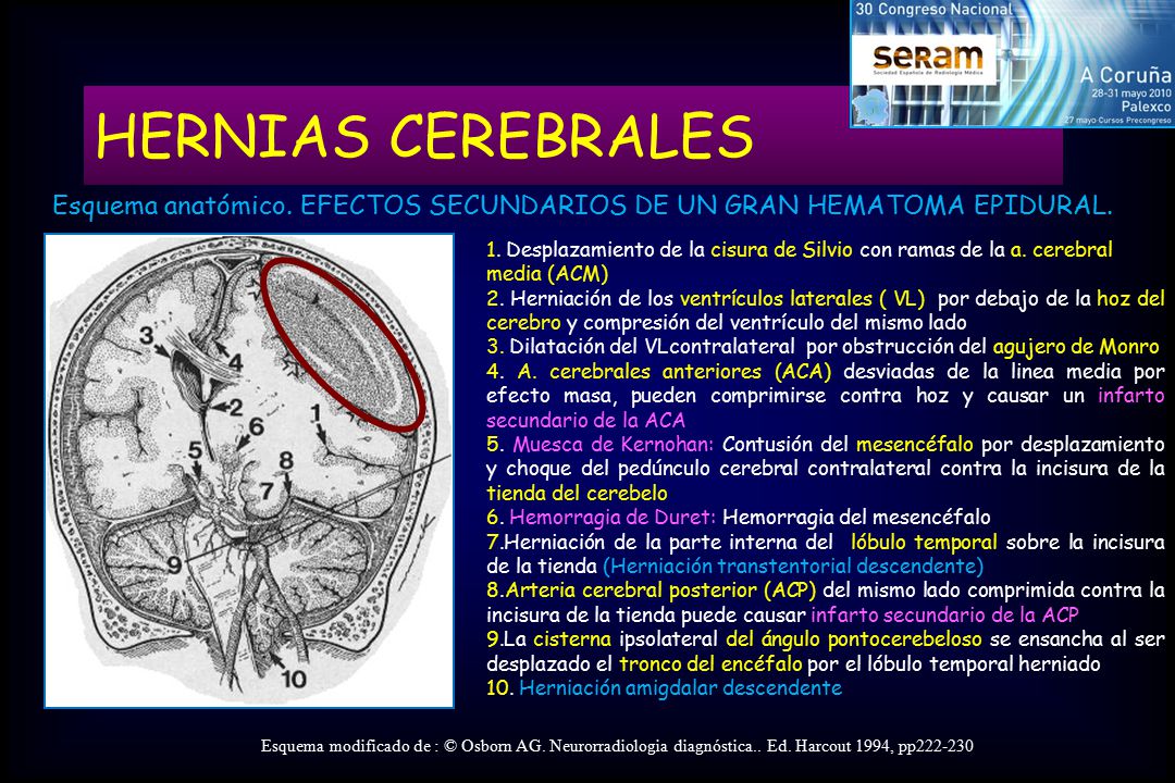 HERNIAS CEREBRALES Esquema anatómico. EFECTOS SECUNDARIOS DE UN GRAN HEMATOMA EPIDURAL.