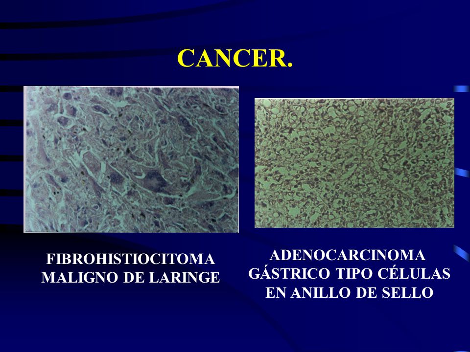 CANCER. ADENOCARCINOMA FIBROHISTIOCITOMA GÁSTRICO TIPO CÉLULAS