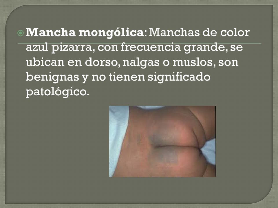 Mancha mongólica: Manchas de color azul pizarra, con frecuencia grande, se ubican en dorso, nalgas o muslos, son benignas y no tienen significado patológico.