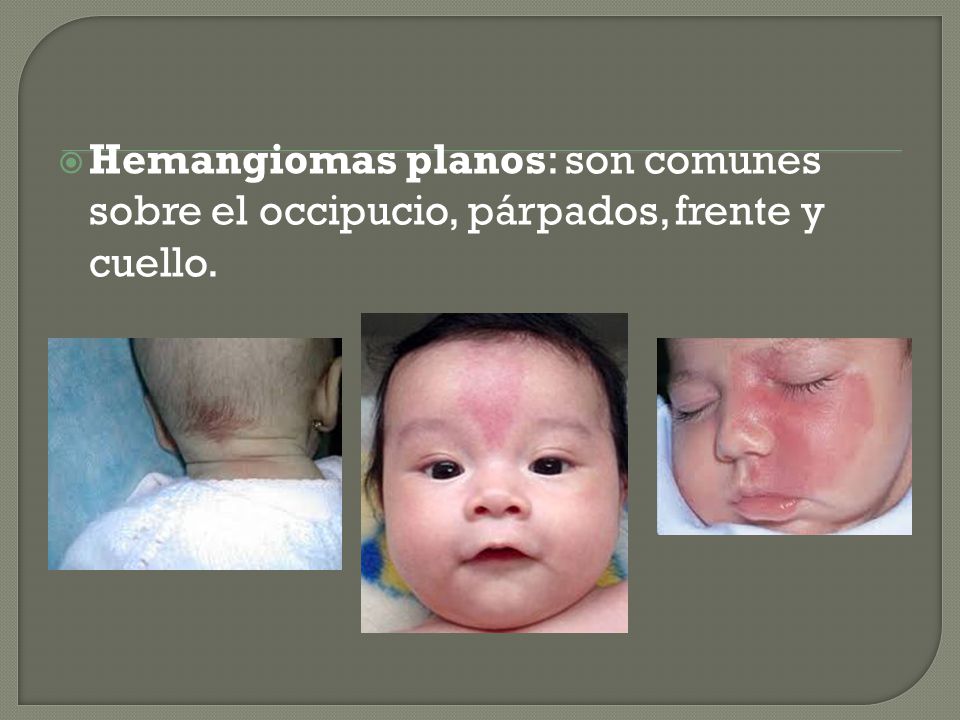 Hemangiomas planos: son comunes sobre el occipucio, párpados, frente y cuello.