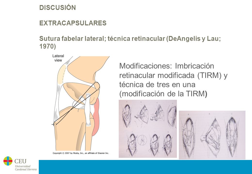 DISCUSIÓN EXTRACAPSULARES Sutura fabelar lateral; técnica retinacular (DeAngelis y Lau; 1970)