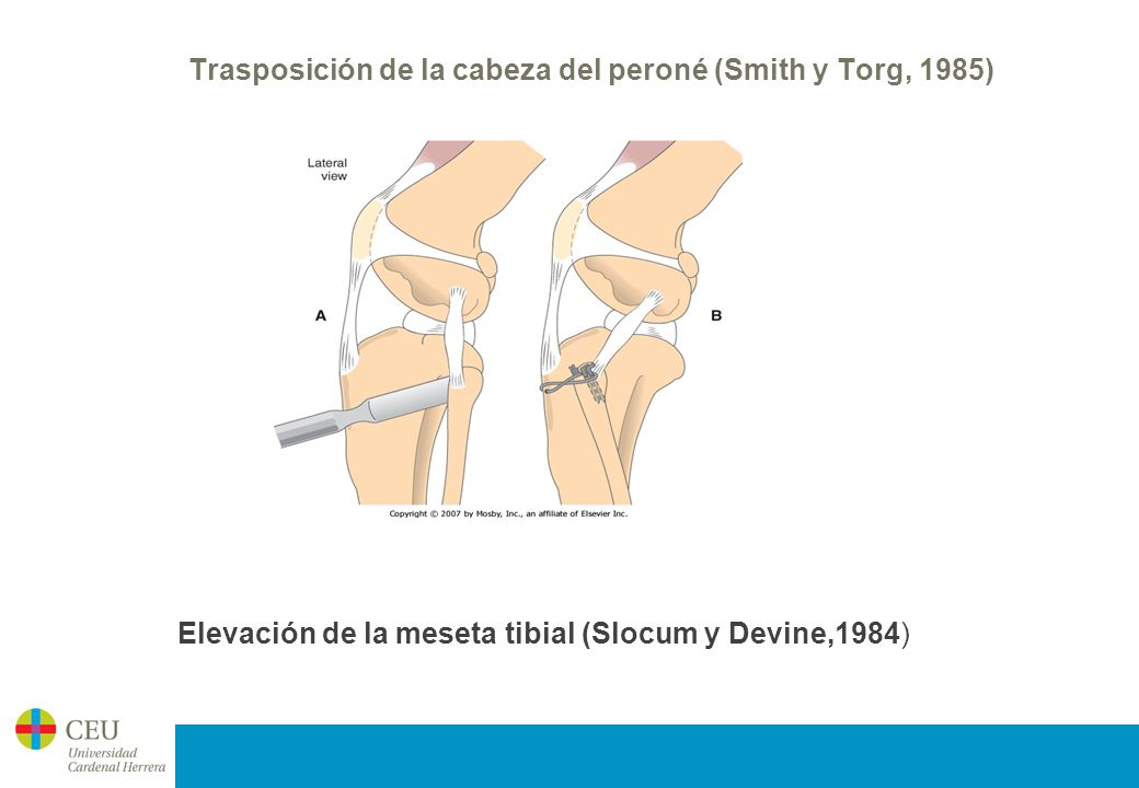 Trasposición de la cabeza del peroné (Smith y Torg, 1985)