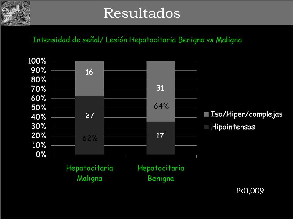 Resultados Intensidad de señal/ Lesión Hepatocitaria Benigna vs Maligna % P<0,009