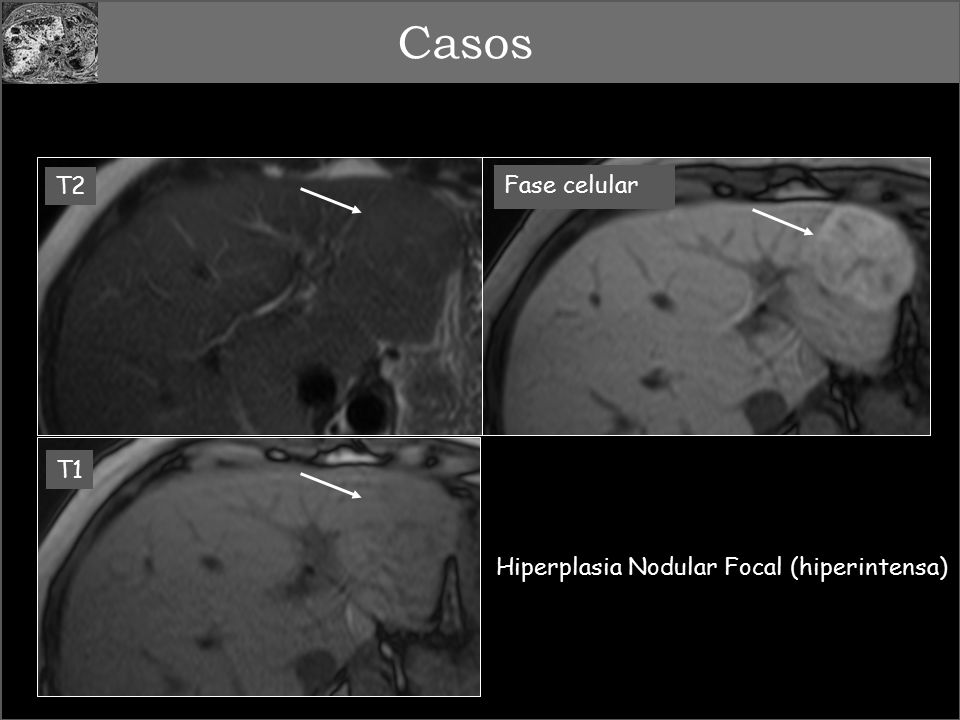 Casos T2 Fase celular 12 T1 Hiperplasia Nodular Focal (hiperintensa)