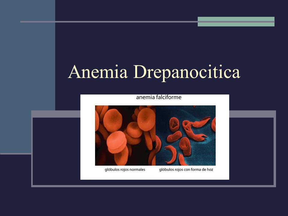 Anemia Drepanocitica