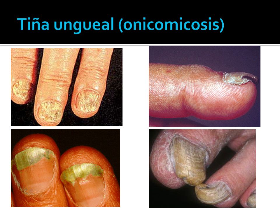 Tiña ungueal (onicomicosis)