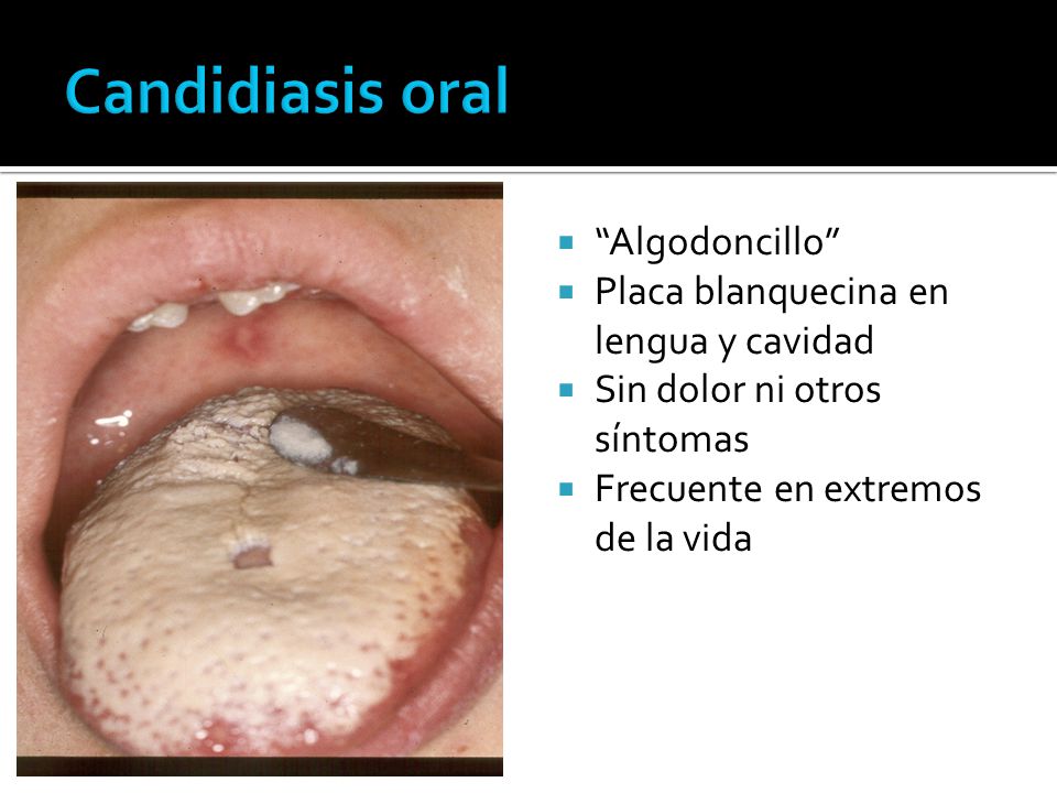 Candidiasis oral Algodoncillo Placa blanquecina en lengua y cavidad