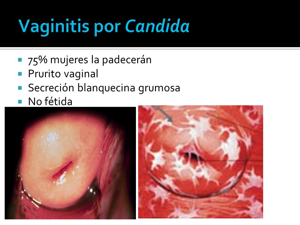 Vaginitis por Candida 75% mujeres la padecerán Prurito vaginal