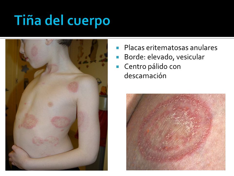 Tiña del cuerpo Placas eritematosas anulares Borde: elevado, vesicular