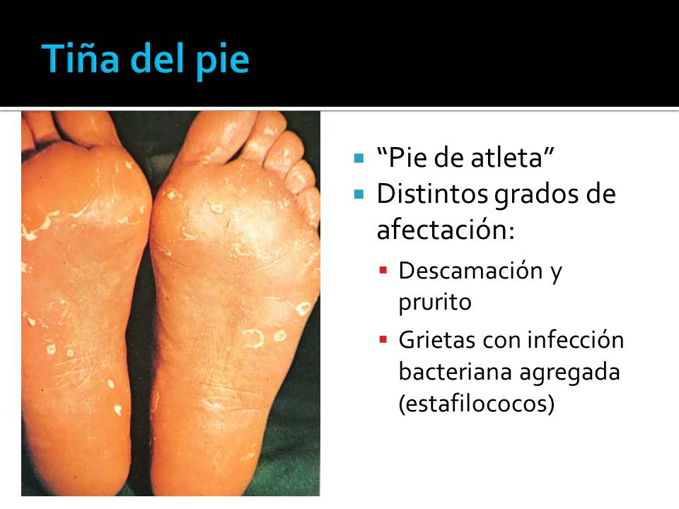Tiña del pie Pie de atleta Distintos grados de afectación: