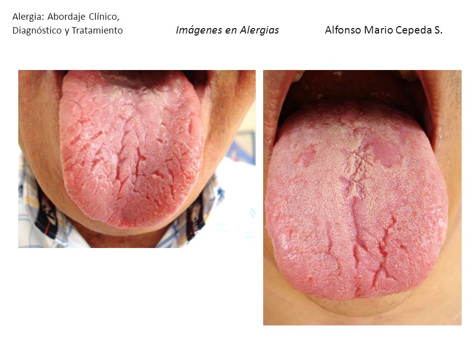 Alergia: Abordaje Clínico, Diagnóstico y Tratamiento Imágenes en Alergias Alfonso Mario Cepeda S.