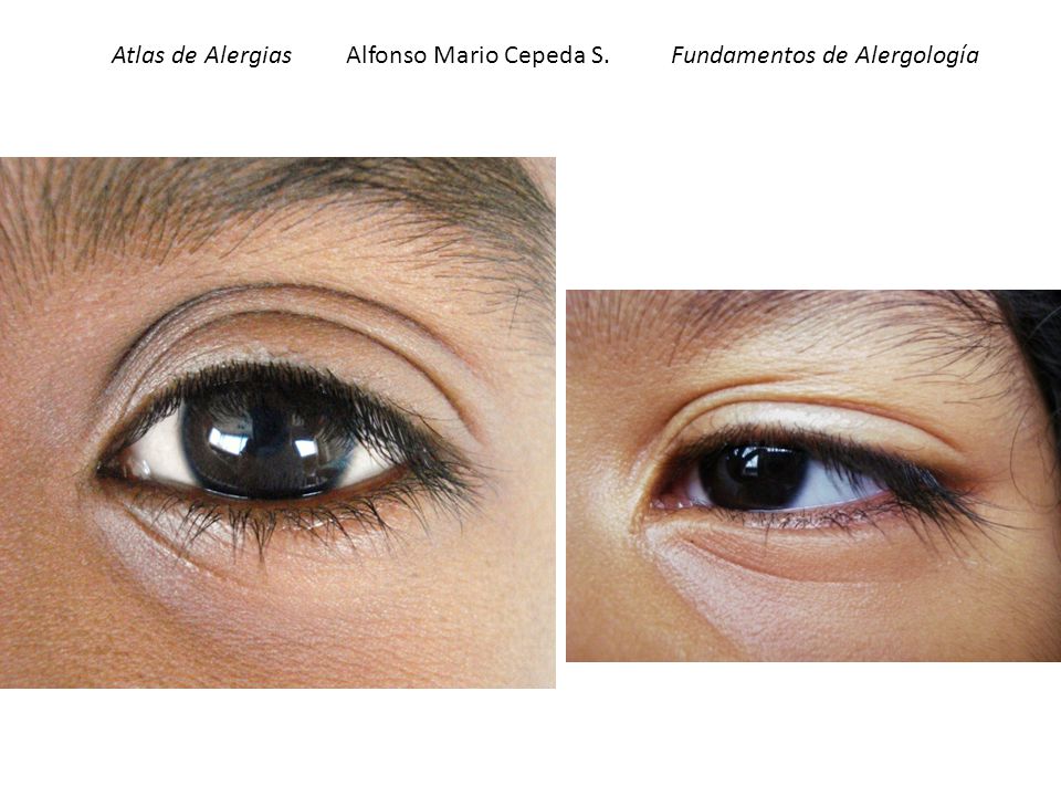 Atlas de Alergias Alfonso Mario Cepeda S. Fundamentos de Alergología