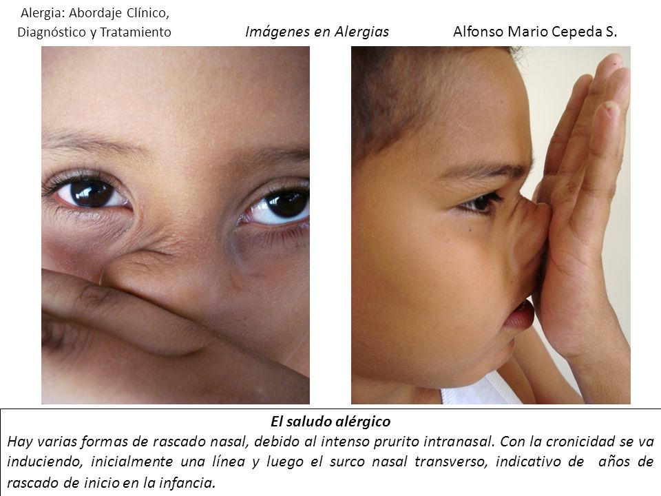 Alergia: Abordaje Clínico, Diagnóstico y Tratamiento Imágenes en Alergias Alfonso Mario Cepeda S.
