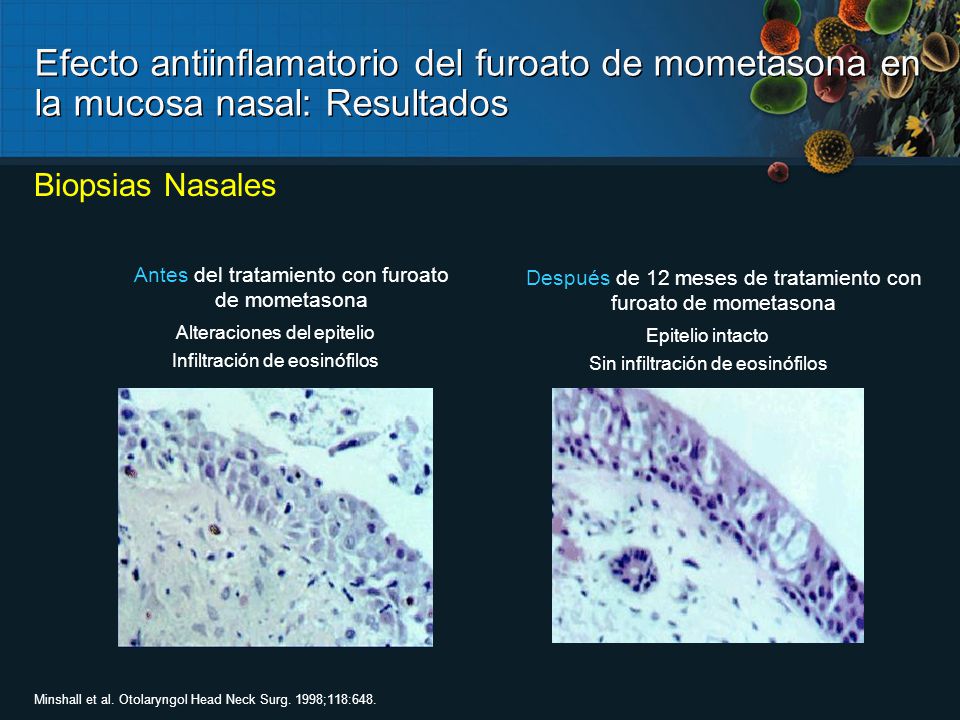 Efecto antiinflamatorio del furoato de mometasona en la mucosa nasal: Resultados