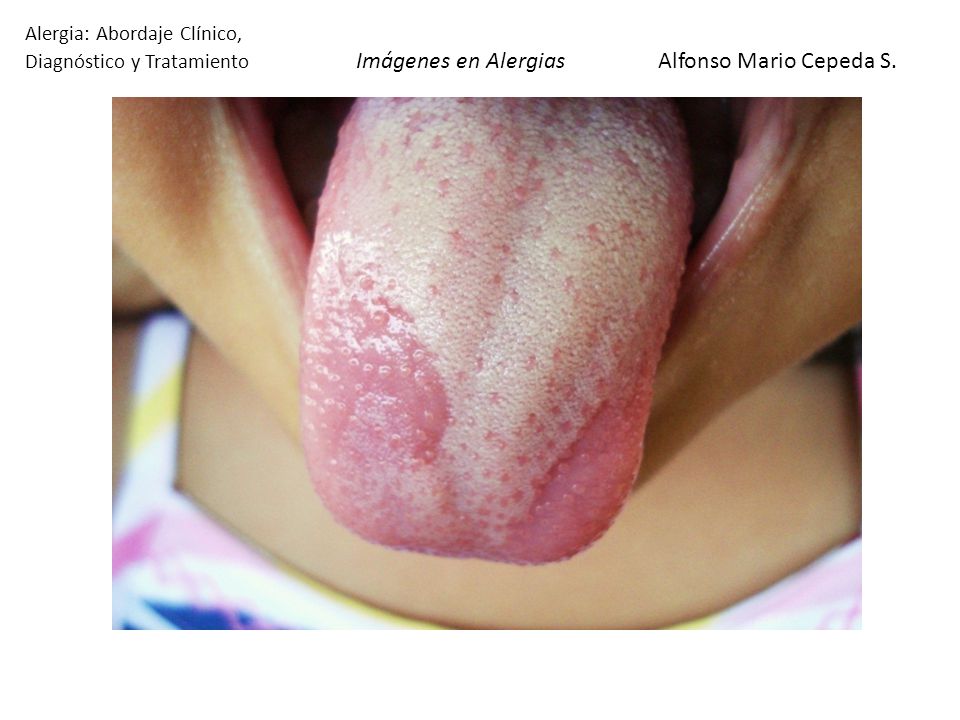 Alergia: Abordaje Clínico, Diagnóstico y Tratamiento Imágenes en Alergias Alfonso Mario Cepeda S.