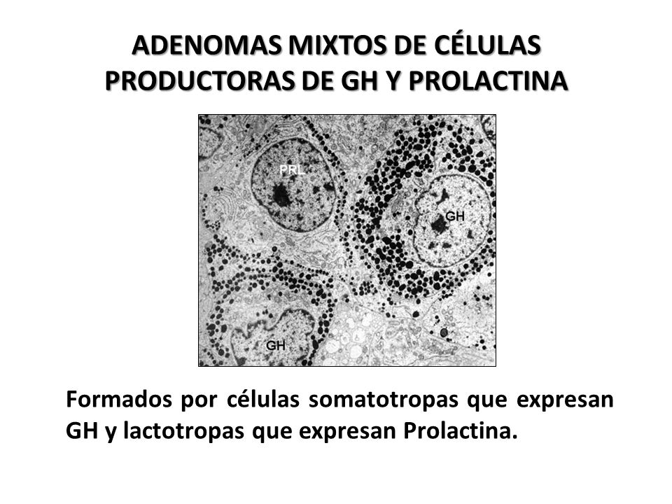 Adenomas Mixtos de células productoras de GH y Prolactina