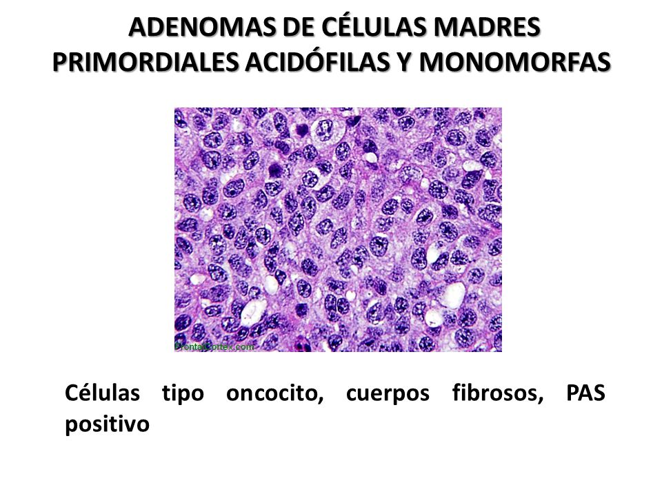 Adenomas de células madres primordiales acidófilas y monomorfas