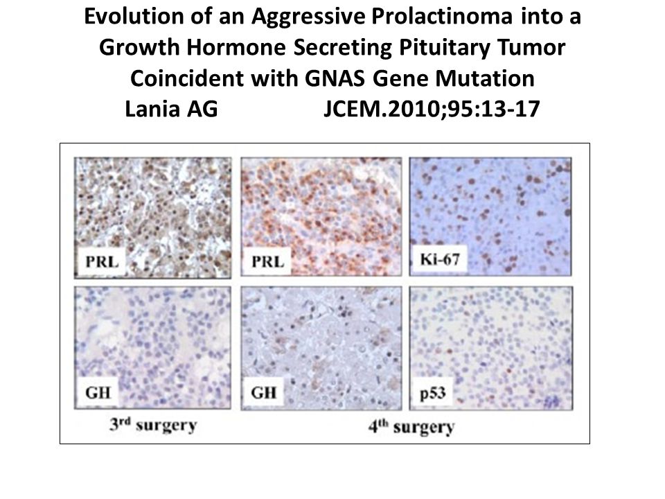 Evolution of an Aggressive Prolactinoma into a Growth Hormone Secreting Pituitary Tumor Coincident with GNAS Gene Mutation Lania AG JCEM.2010;95:13-17