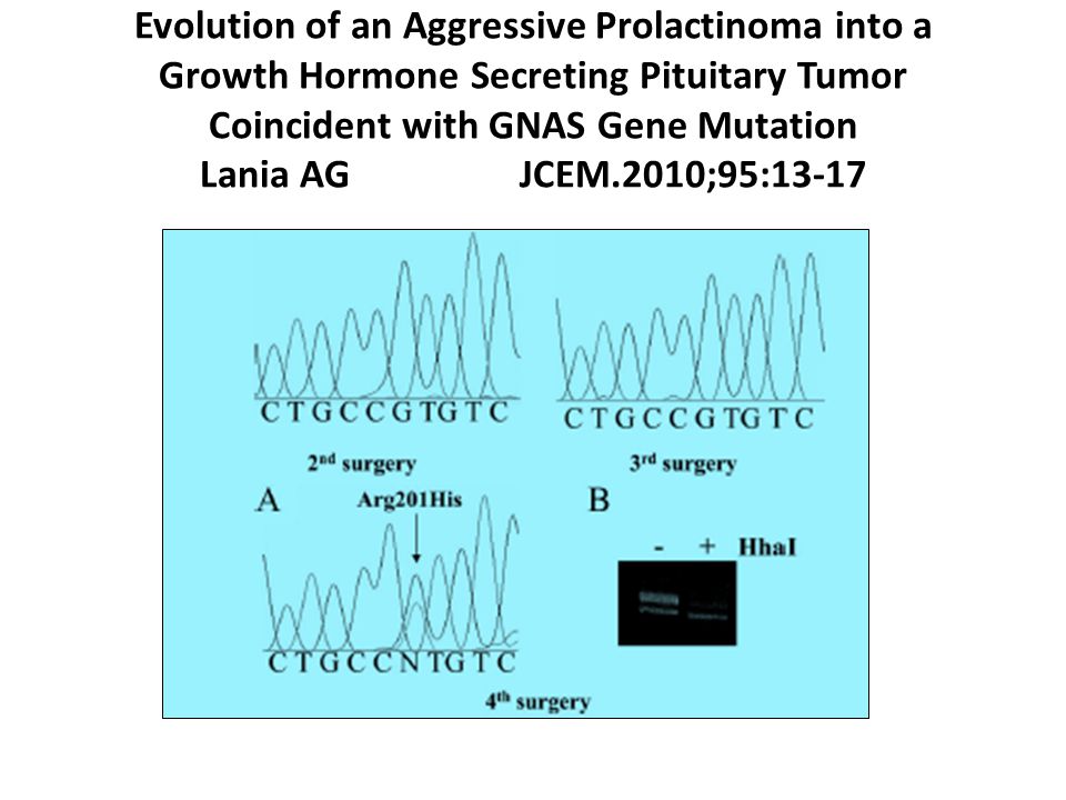 Evolution of an Aggressive Prolactinoma into a Growth Hormone Secreting Pituitary Tumor Coincident with GNAS Gene Mutation Lania AG JCEM.2010;95:13-17