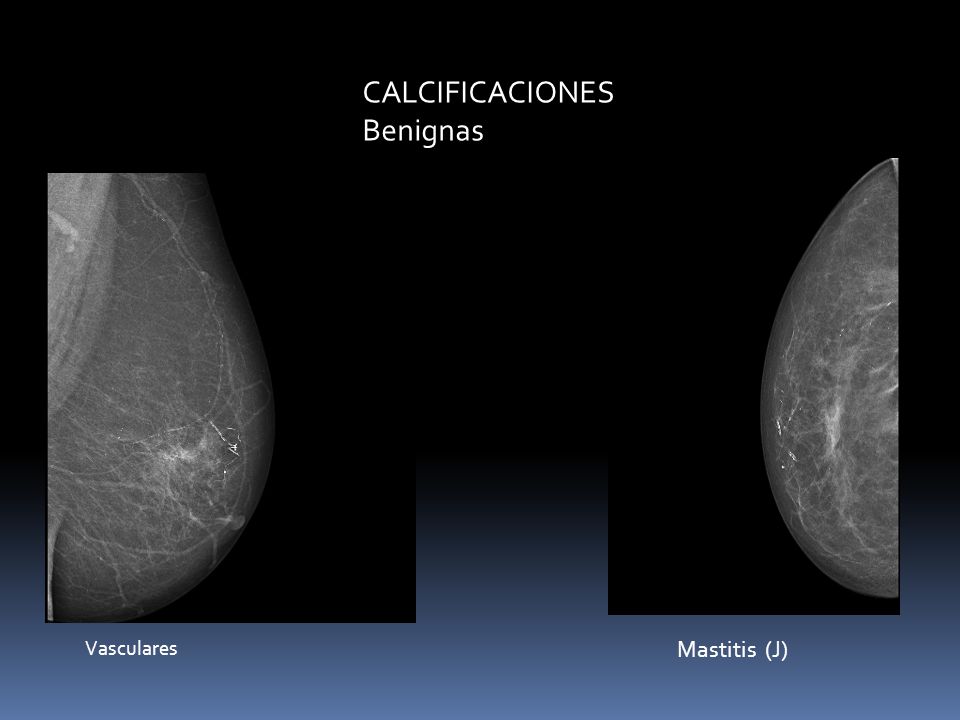 CALCIFICACIONES Benignas Vasculares Mastitis (J) Pop corn