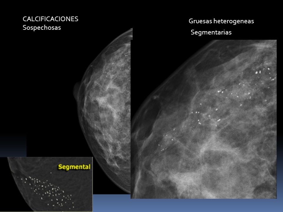 CALCIFICACIONES Sospechosas Gruesas heterogeneas Segmentarias