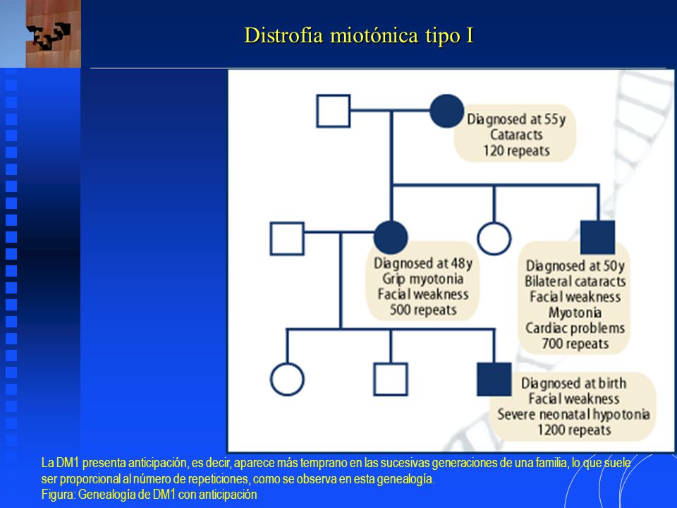 Distrofia miotónica tipo I