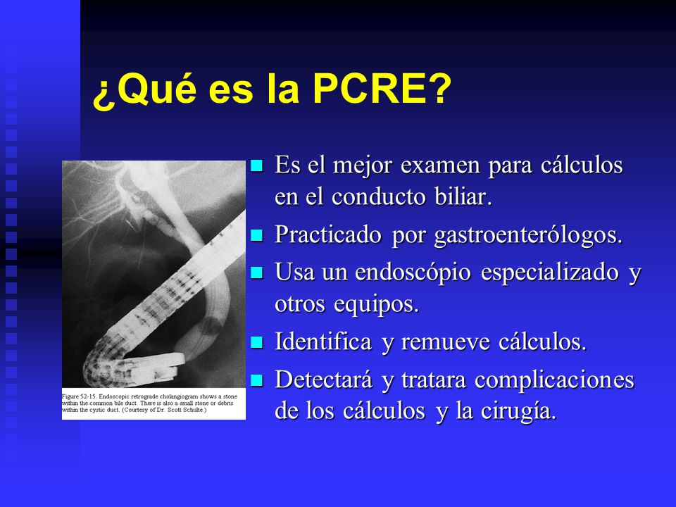 ¿Qué es la PCRE Es el mejor examen para cálculos en el conducto biliar. Practicado por gastroenterólogos.