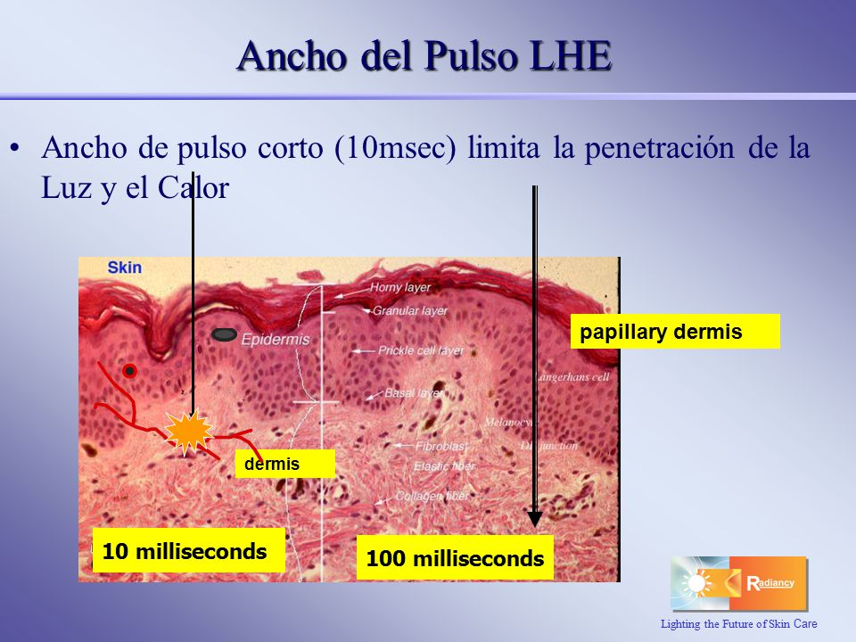 Ancho del Pulso LHE Ancho de pulso corto (10msec) limita la penetración de la Luz y el Calor. papillary dermis.