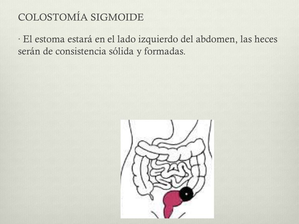 COLOSTOMÍA SIGMOIDE · El estoma estará en el lado izquierdo del abdomen, las heces serán de consistencia sólida y formadas.