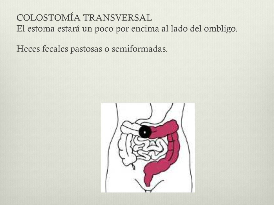 COLOSTOMÍA TRANSVERSAL El estoma estará un poco por encima al lado del ombligo.