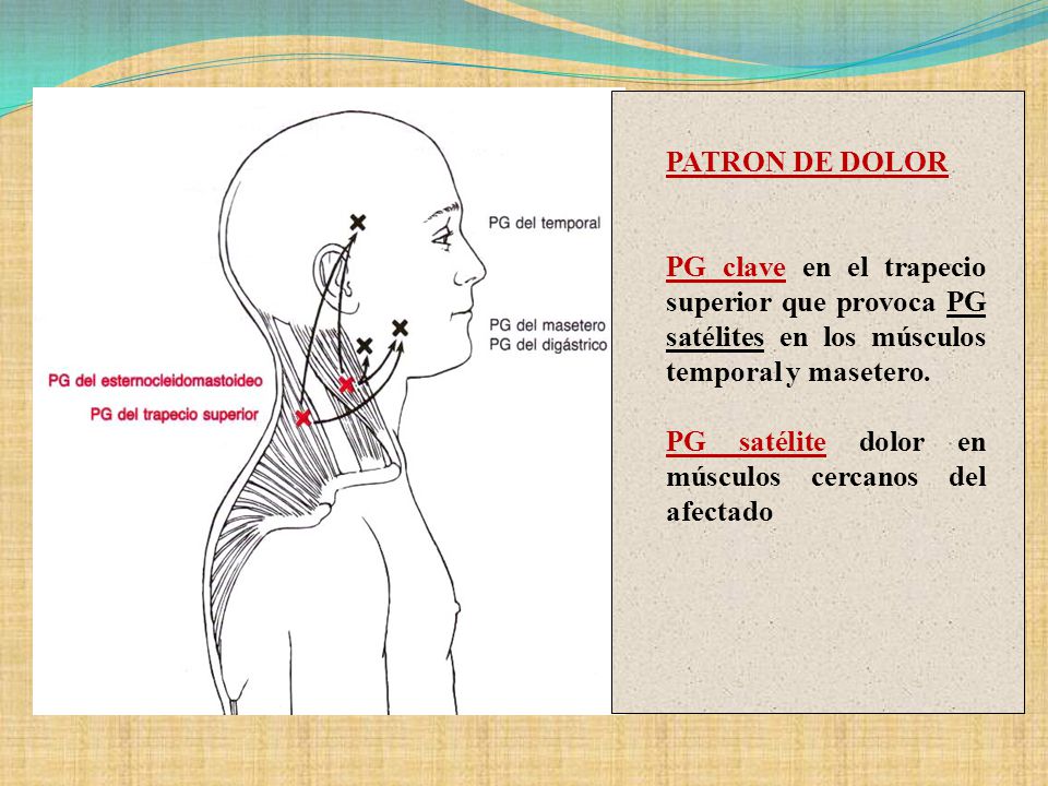 PATRON DE DOLOR PG clave en el trapecio superior que provoca PG satélites en los músculos temporal y masetero.