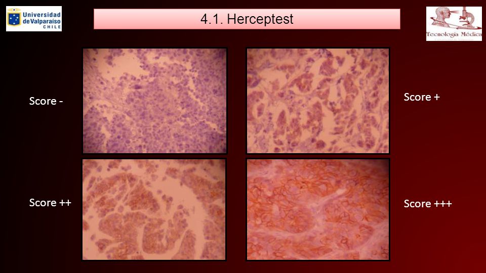4.1. Herceptest Score + Score - Score ++ Score +++