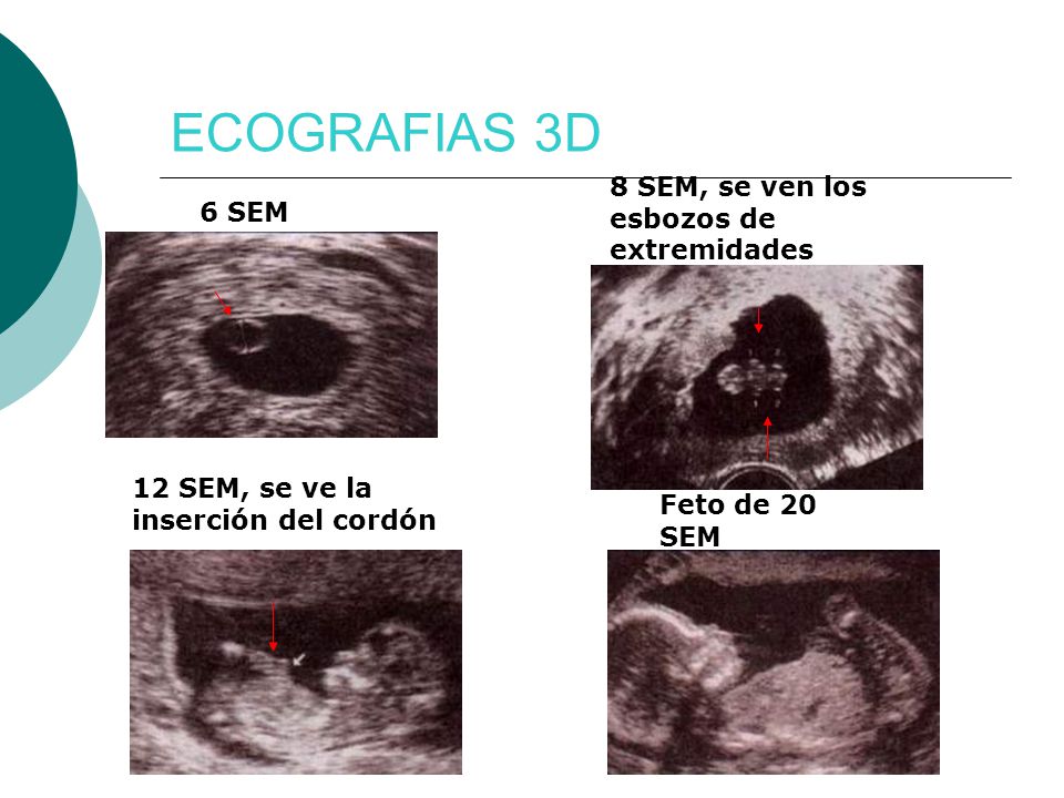 ECOGRAFIAS 3D 8 SEM, se ven los esbozos de extremidades 6 SEM