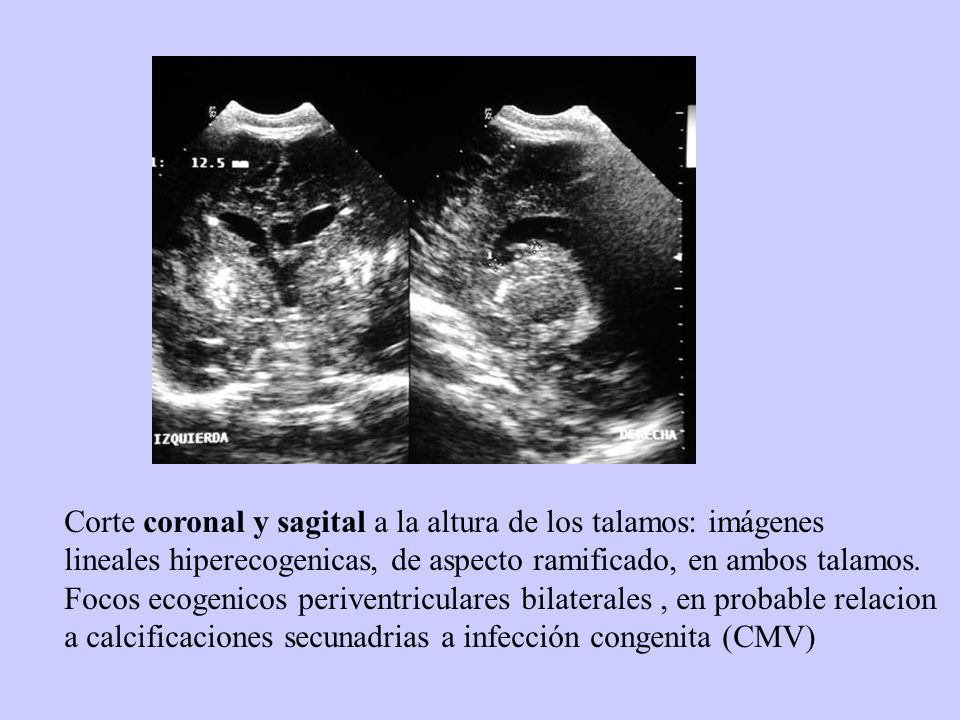 Corte coronal y sagital a la altura de los talamos: imágenes