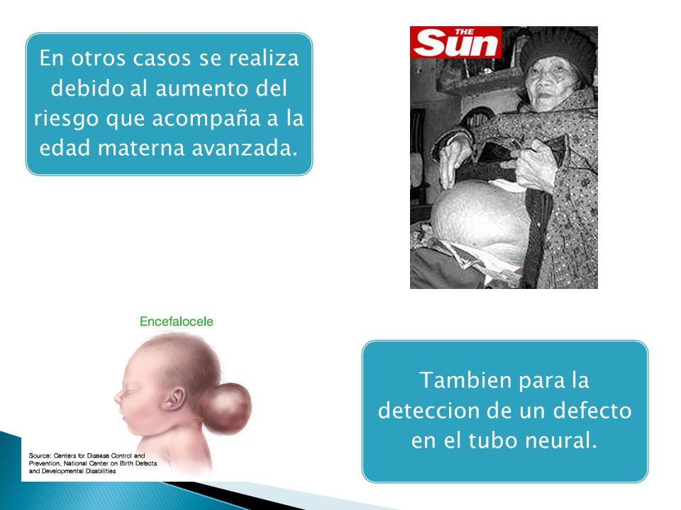 Tambien para la deteccion de un defecto en el tubo neural.