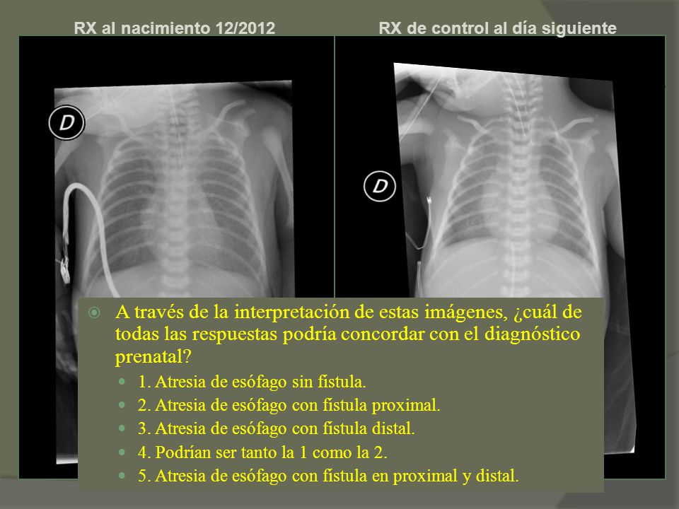 RX al nacimiento 12/2012 RX de control al día siguiente.