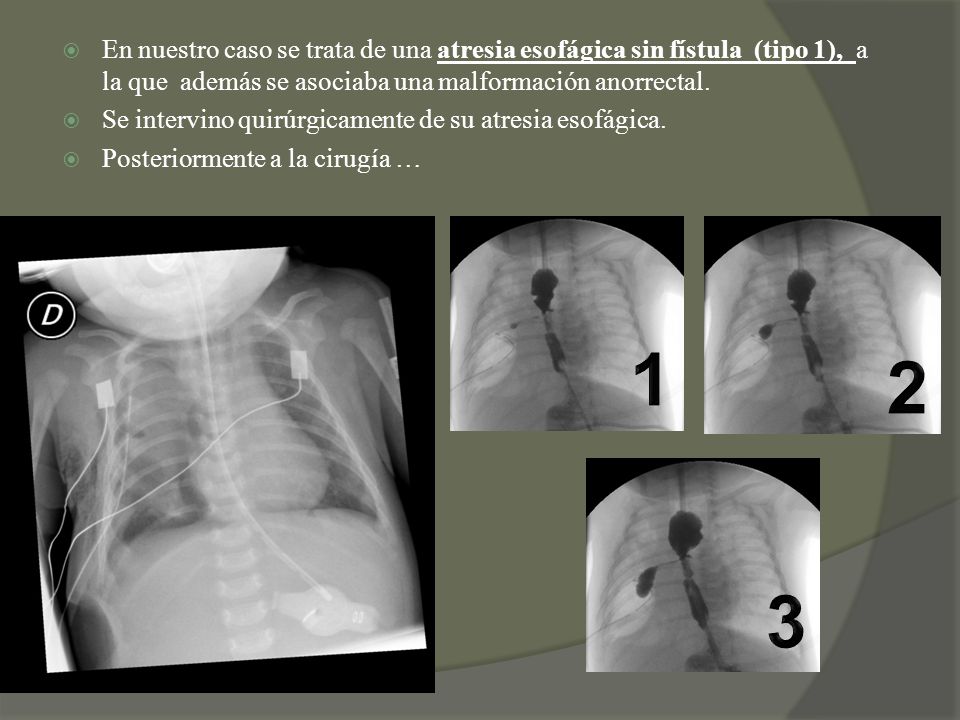 En nuestro caso se trata de una atresia esofágica sin fístula (tipo 1), a la que además se asociaba una malformación anorrectal.