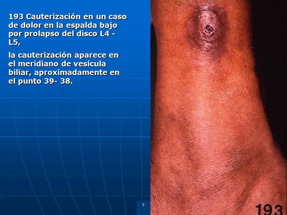 193 Cauterización en un caso de dolor en la espalda bajo por prolapso del disco L4 - L5,