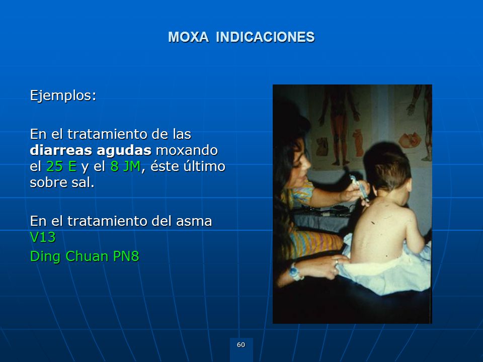 MOXA INDICACIONES Ejemplos: En el tratamiento de las diarreas agudas moxando el 25 E y el 8 JM, éste último sobre sal.
