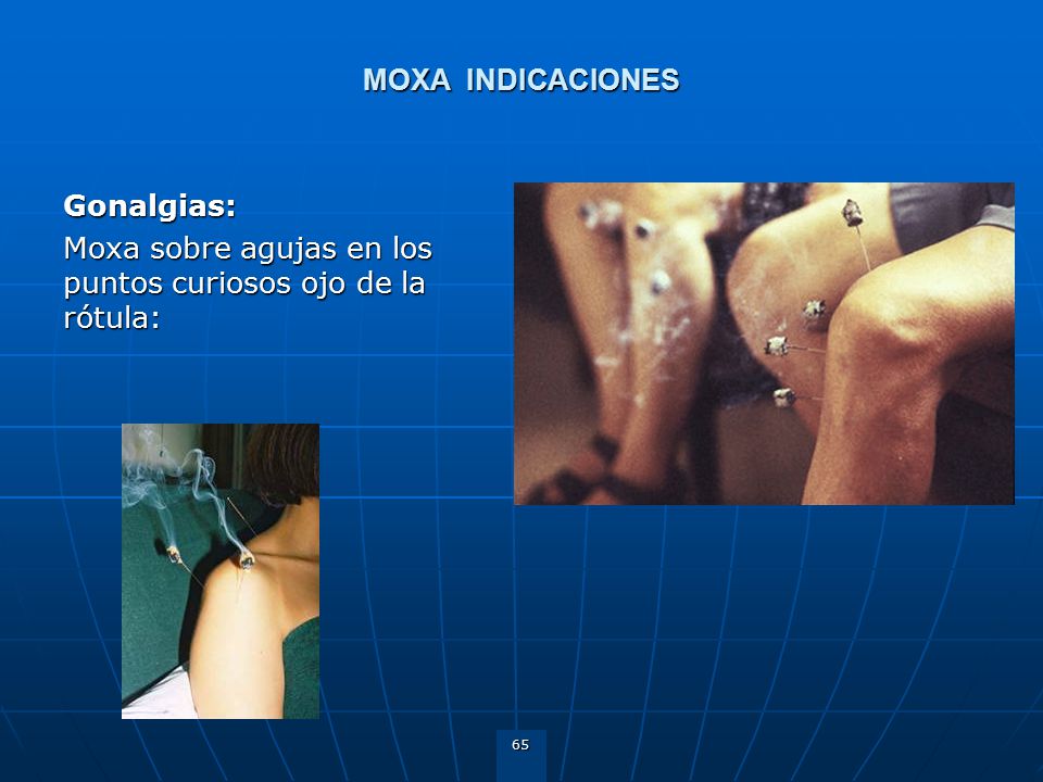 MOXA INDICACIONES Gonalgias: Moxa sobre agujas en los puntos curiosos ojo de la rótula: