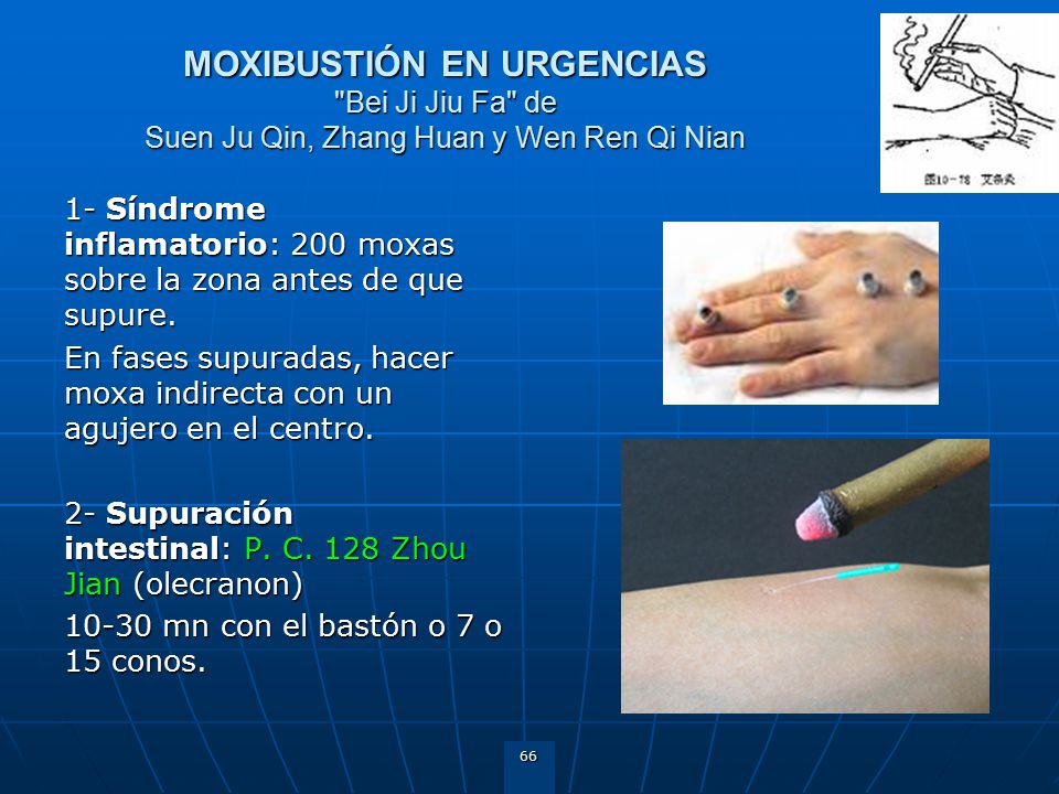 MOXIBUSTIÓN EN URGENCIAS Bei Ji Jiu Fa de Suen Ju Qin, Zhang Huan y Wen Ren Qi Nian