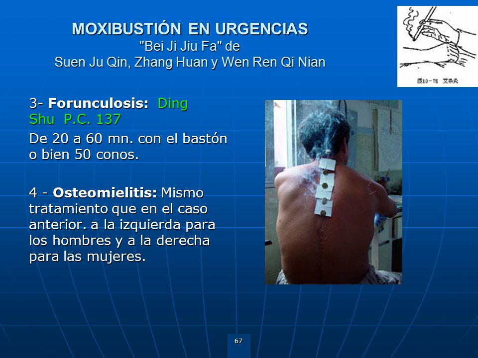 MOXIBUSTIÓN EN URGENCIAS Bei Ji Jiu Fa de Suen Ju Qin, Zhang Huan y Wen Ren Qi Nian